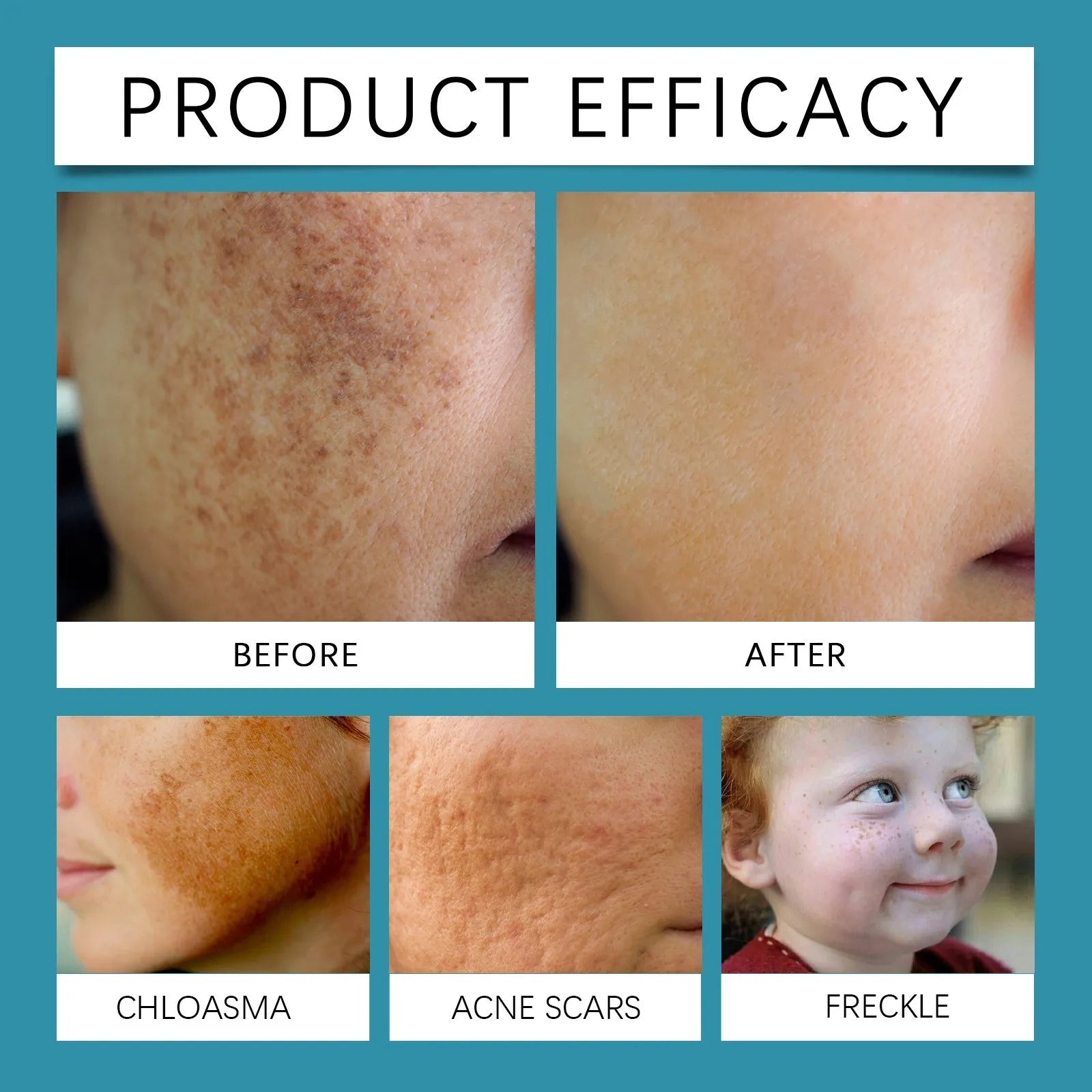 Blue Light Clear Pen – Fast & Easy Mole and Pigmentation Correction Without Pain or Scars