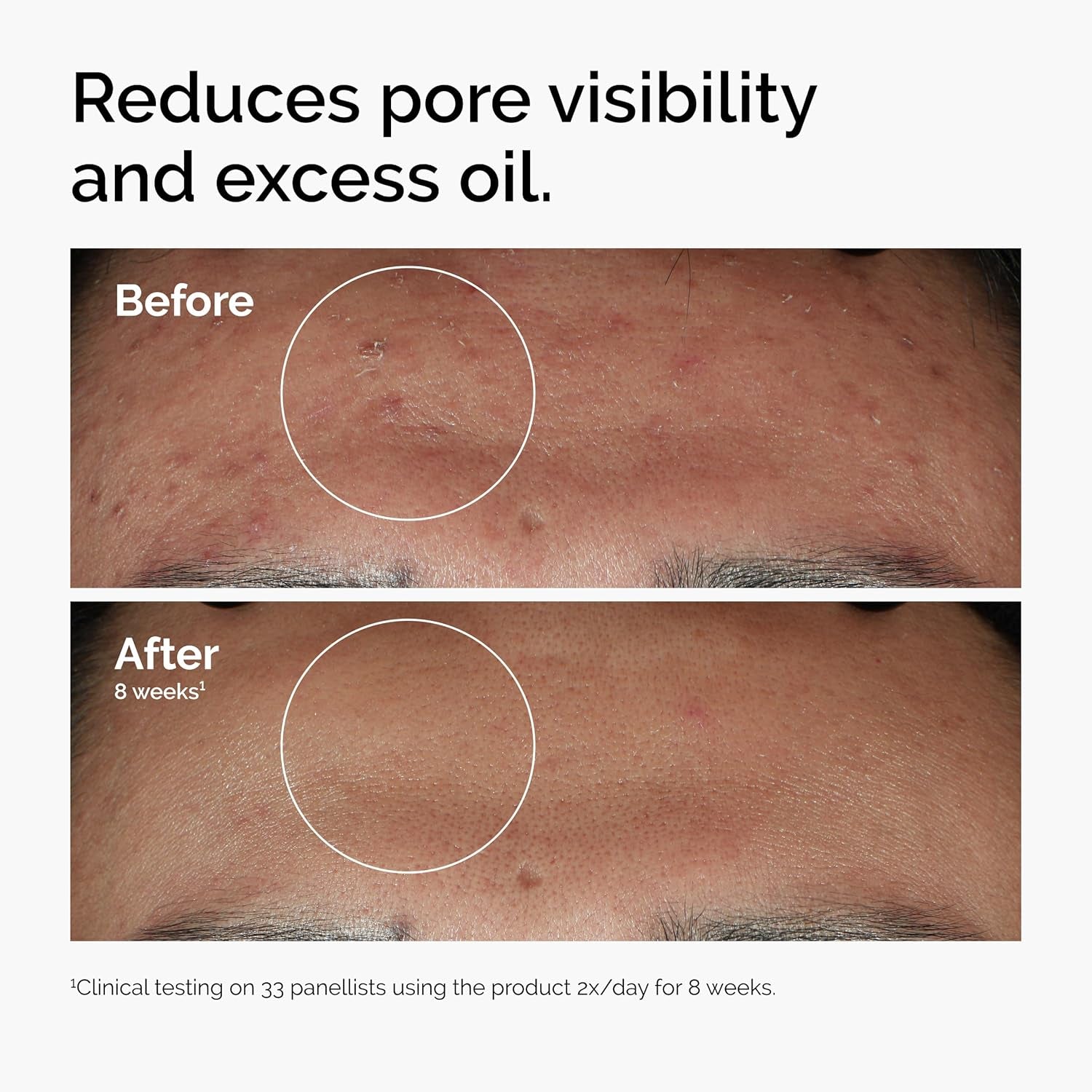 PorePerfect™ Niacinamide 10% + Zinc 1% Serum – Fights Blemishes, Controls Oil & Refines Texture | 1 fl oz Glow Boosting Treatment