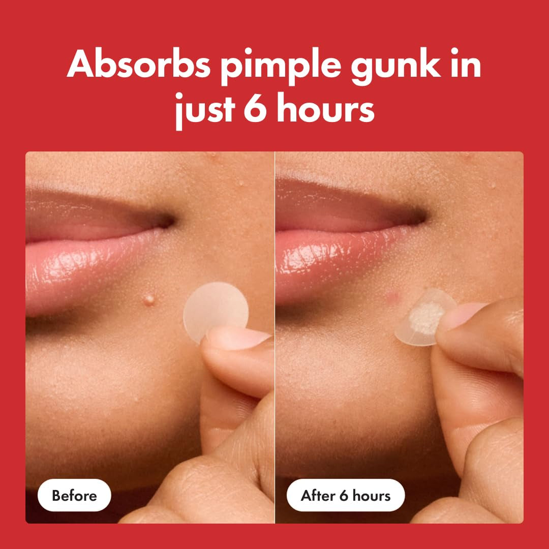 Hero™ Original Acne Patch – Fast-Acting Hydrocolloid Stickers That Shrink Pimples in 1 Use | 36 Spot-Saving Patches for Clearer Skin