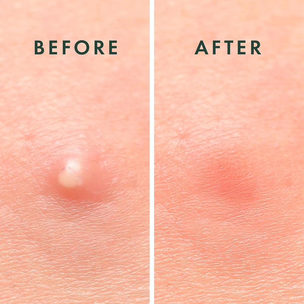 ClearSkin Miracle Patches – Invisible Hydrocolloid Dots That Shrink Pimples Fast | Korean Acne Care in 2 Sizes | 96 Spot Covers