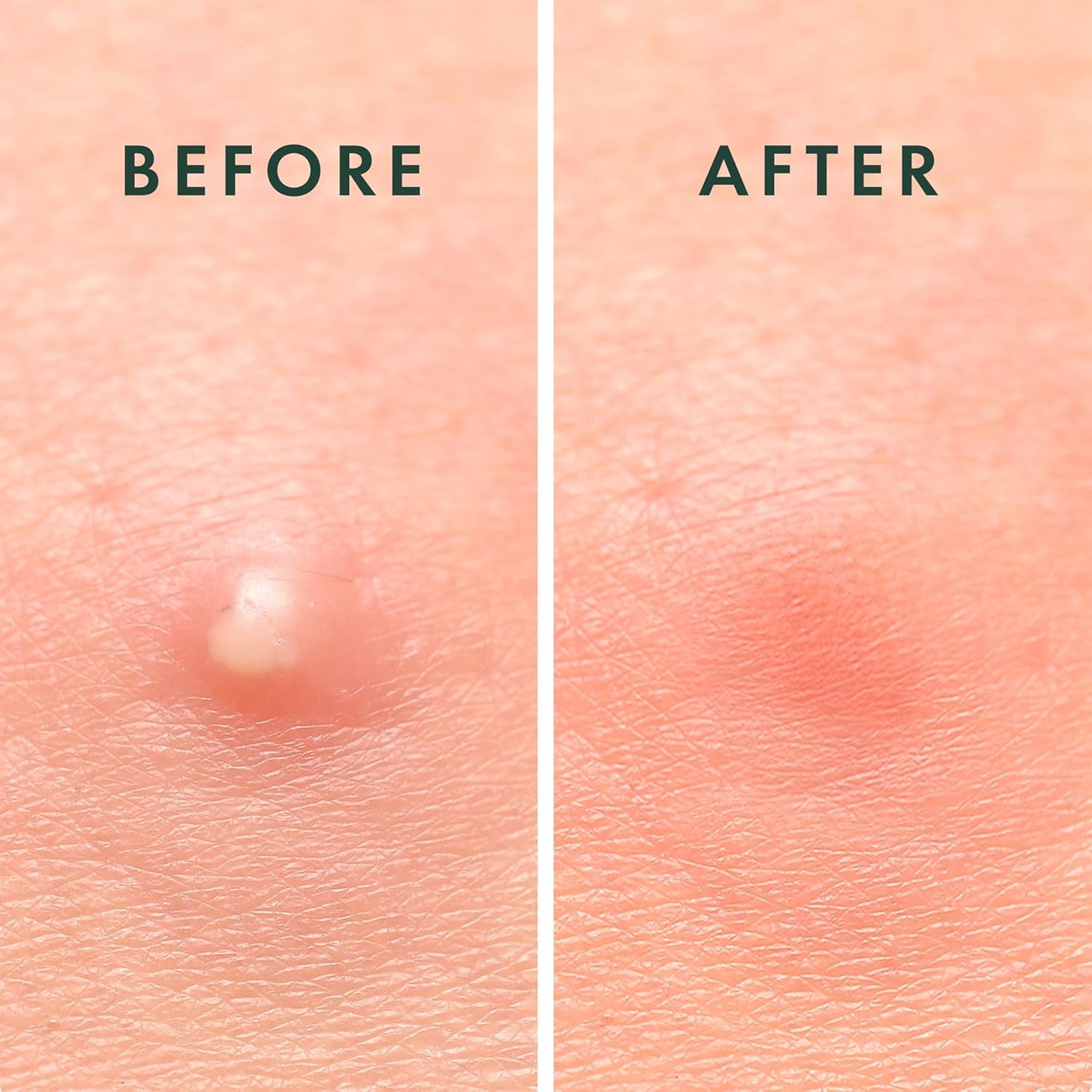 ClearSkin Miracle Patches – Invisible Hydrocolloid Dots That Shrink Pimples Fast | Korean Acne Care in 2 Sizes | 96 Spot Covers
