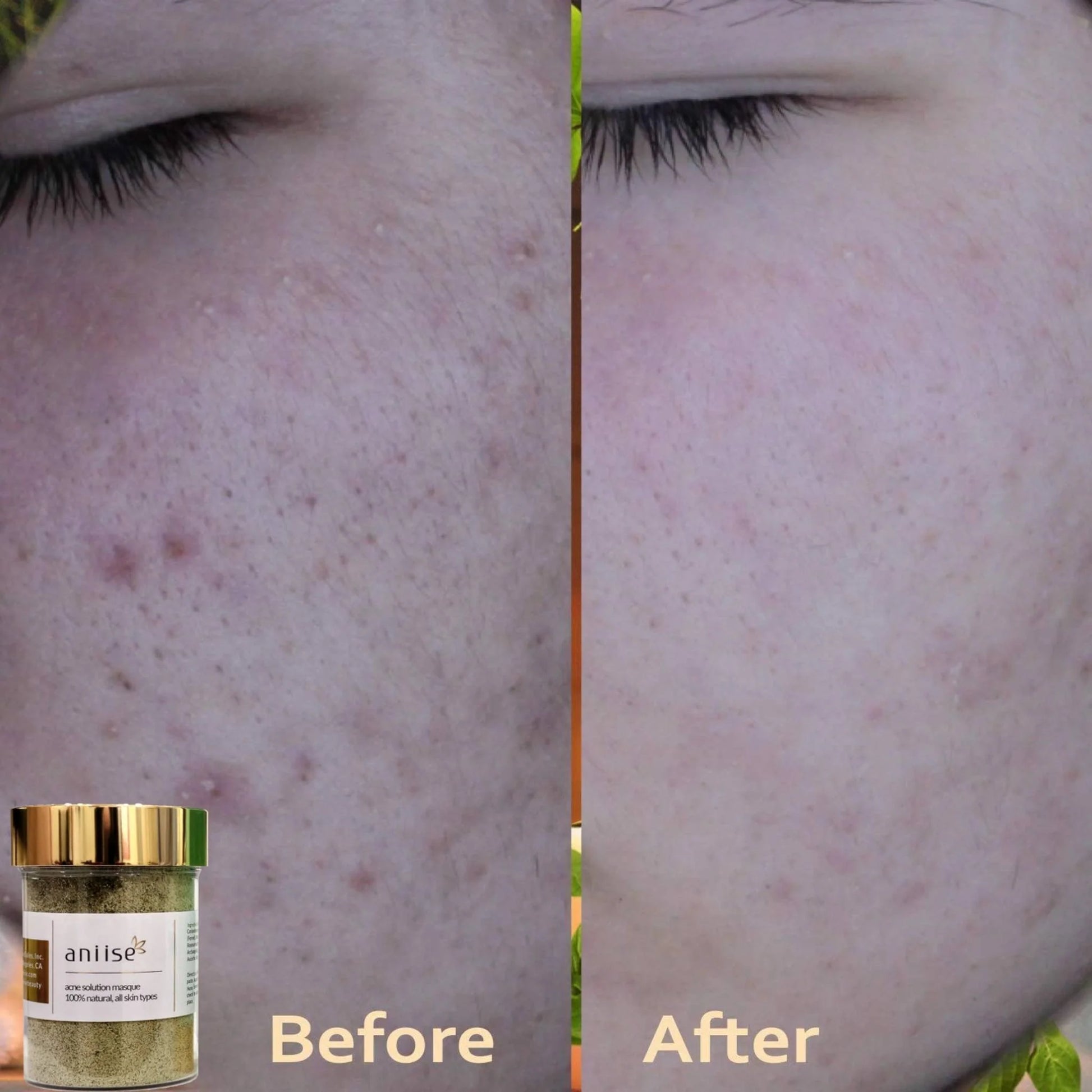 Clear Skin Acne Solution Kit